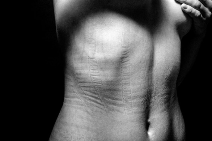 Следы от корсета.  Автор фото: Джастин Бартелс (Justin Bartels).
