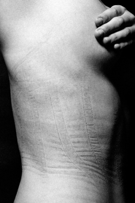 Следы от корсета. Автор фото: Джастин Бартелс (Justin Bartels).