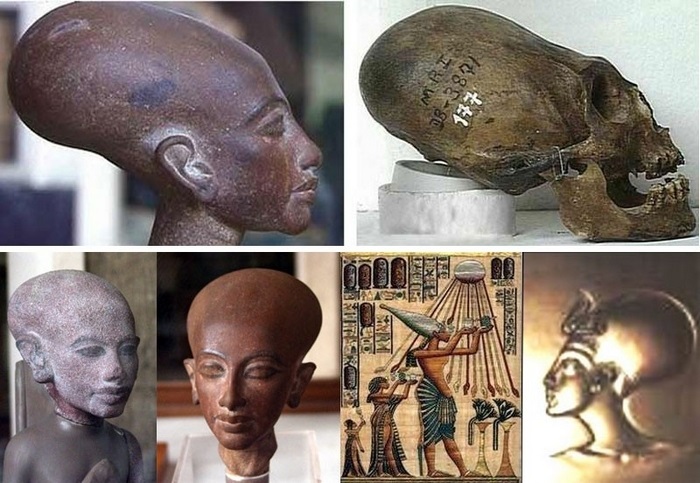 Схожим физическим дефектом обладали египетский фараон Эхнатон и его потомки