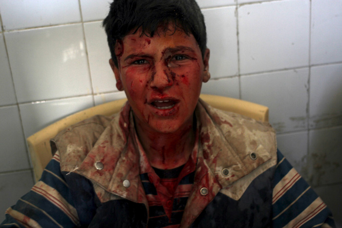 Мальчик, раненый в деревне Аин Ларуз при атаке сил, лояльных Президенту Сирии. 15 мая 2015г.