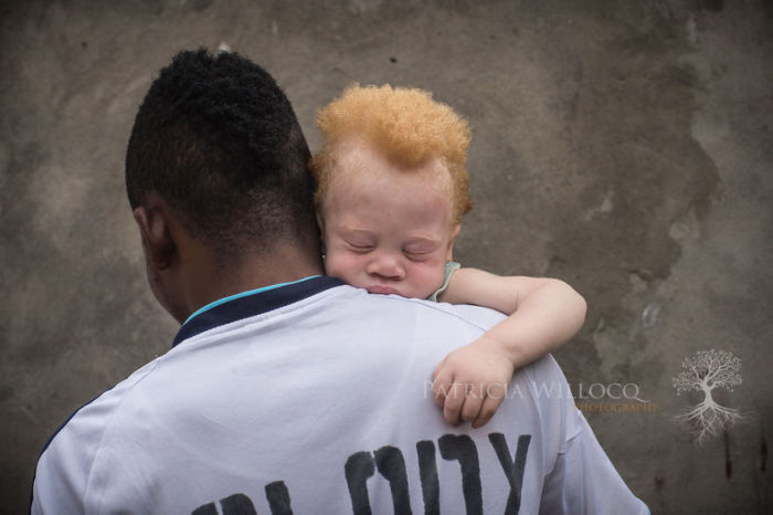 Младенец-альбинос мирно уснул на руках у отца.